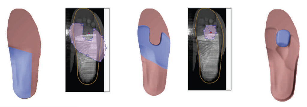 Case Study 10 – Paromed – Custom orthotics & German engineered ...